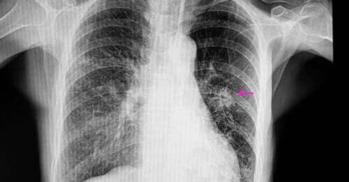 Qu'est-ce qu'un nodule pulmonaire ?