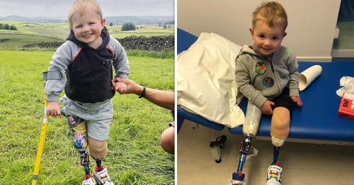 L’enfant de 4 ans perd ses jambes à cause d’une septicémie et marche enfin pour la première fois