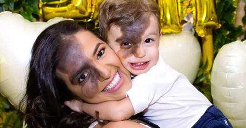 Une mère dessine une tache de naissance sur son visage pour ressembler à son fils : elle veut lui apprendre à s’accepter